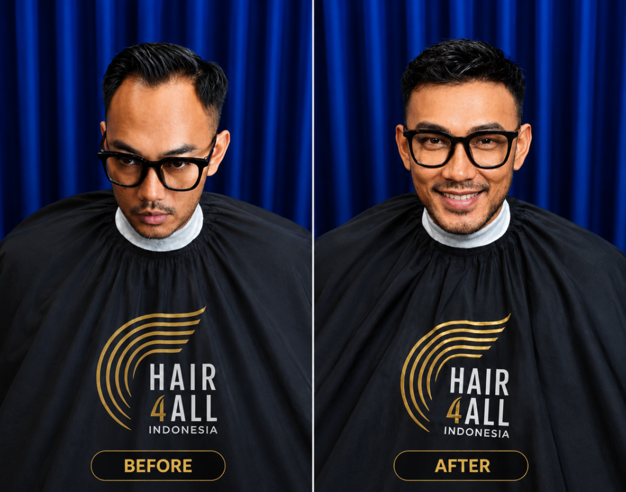 Transformasi klien Hair4All Indonesia 8 — sebelum dan sesudah hair replacement