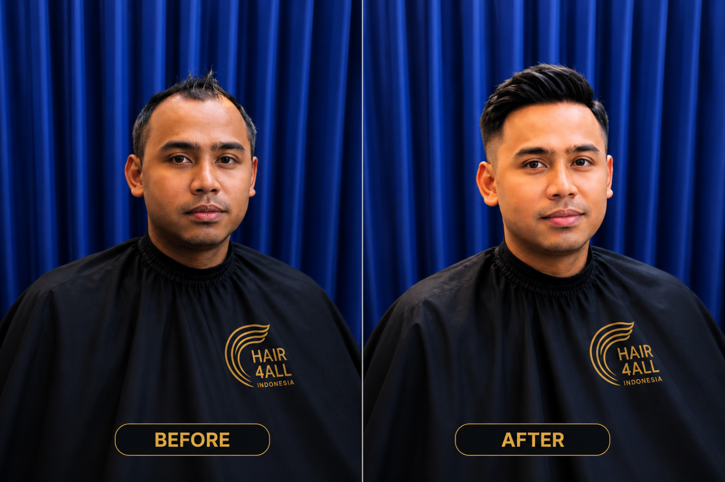 Transformasi klien Hair4All Indonesia 3 — sebelum dan sesudah hair replacement