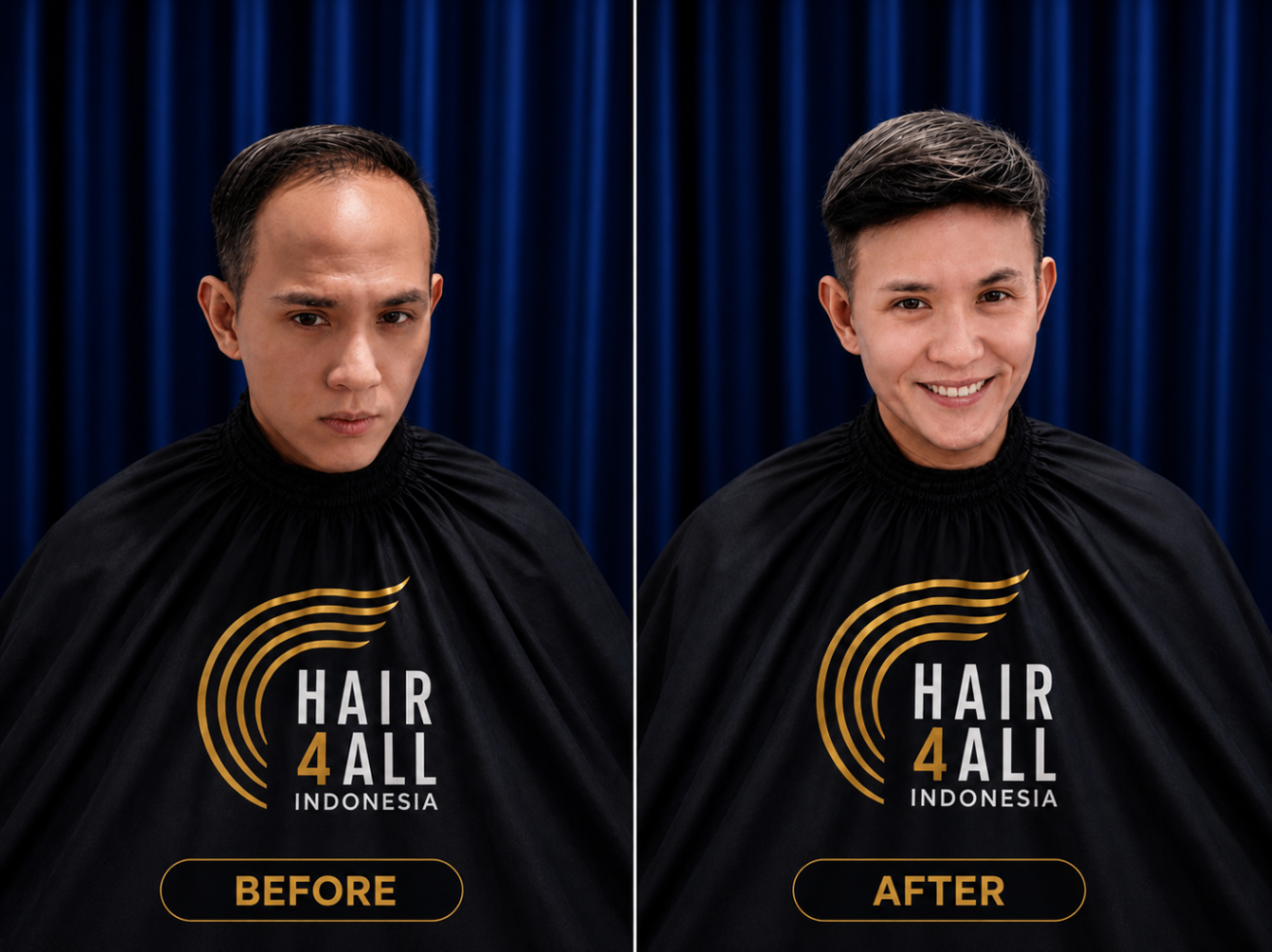 Transformasi klien Hair4All Indonesia 11 — sebelum dan sesudah hair replacement