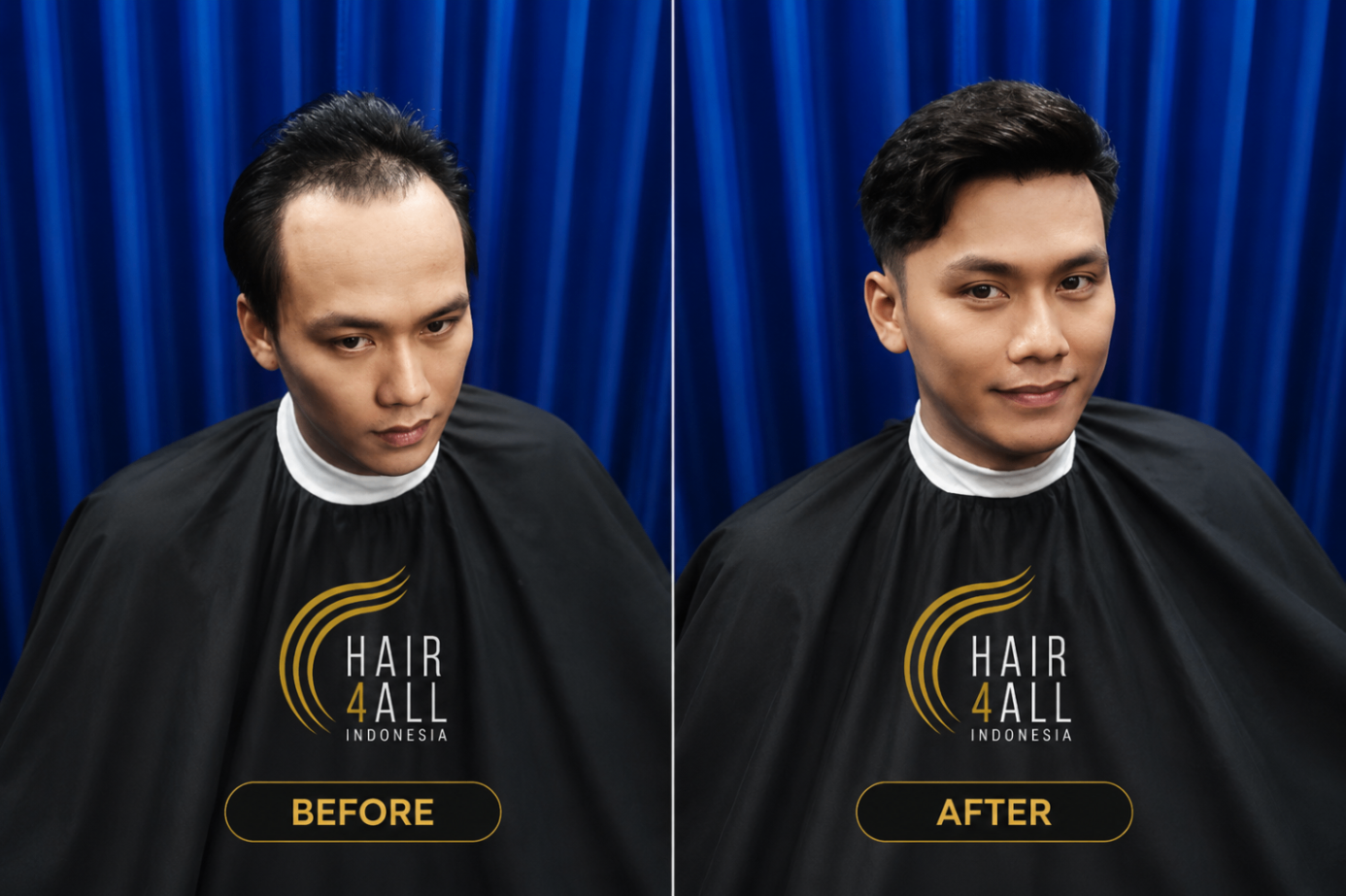 Transformasi klien Hair4All Indonesia 2 — sebelum dan sesudah hair replacement