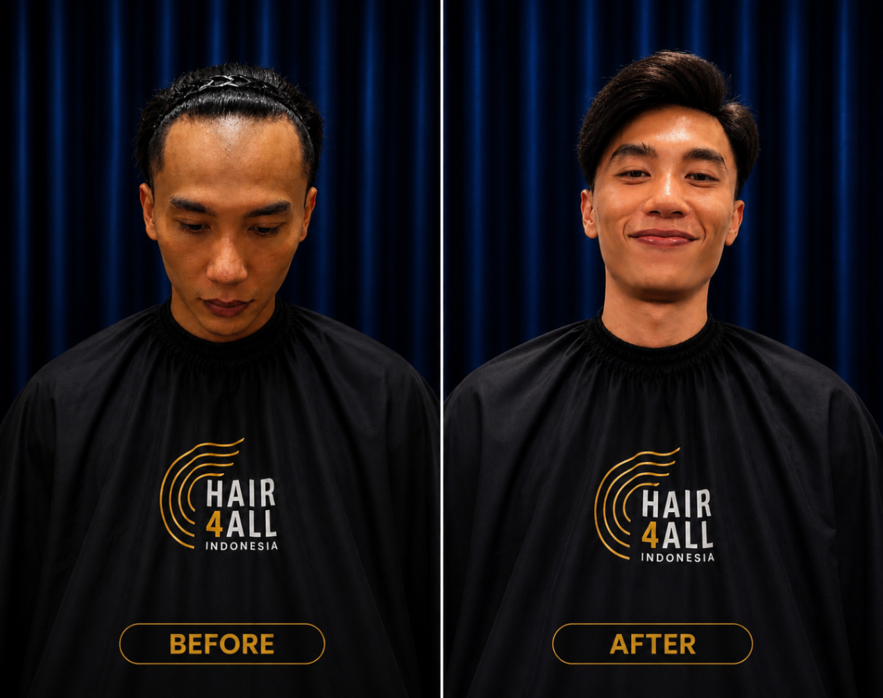 Transformasi klien Hair4All Indonesia 14 — sebelum dan sesudah hair replacement