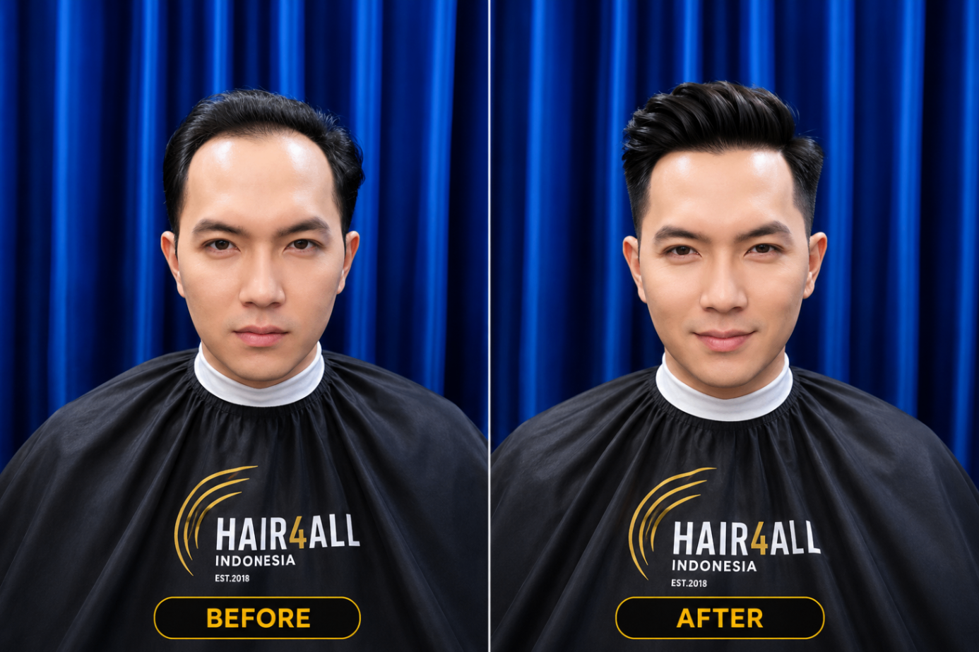 Transformasi klien Hair4All Indonesia 13 — sebelum dan sesudah hair replacement