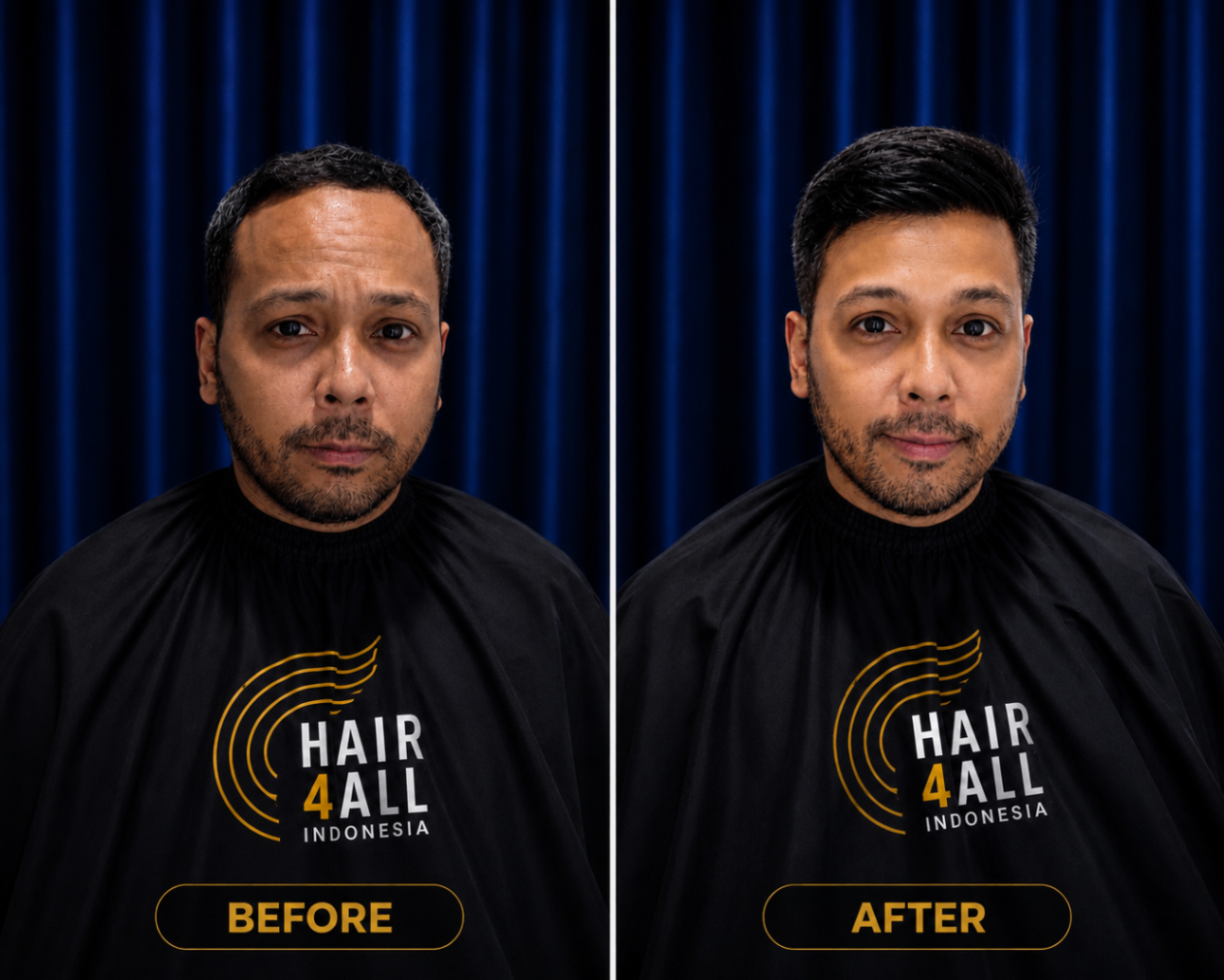 Transformasi klien Hair4All Indonesia 12 — sebelum dan sesudah hair replacement