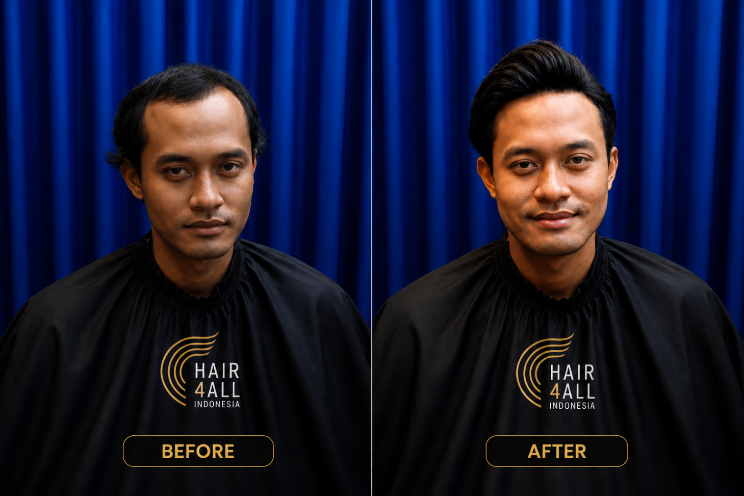 Transformasi klien Hair4All Indonesia 6 — sebelum dan sesudah hair replacement