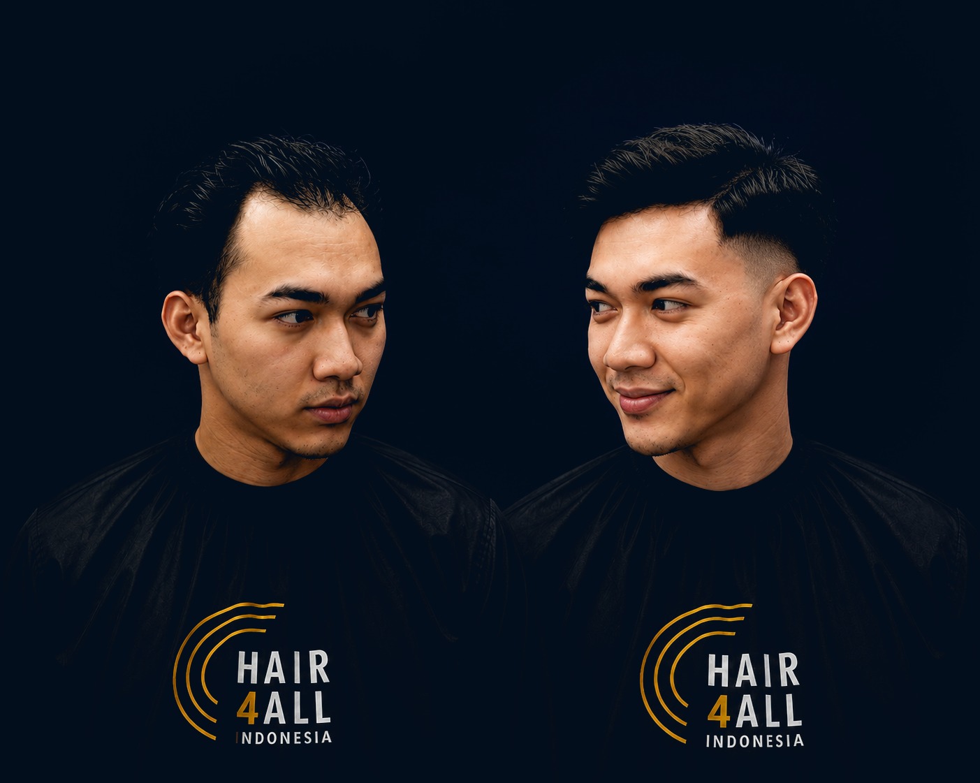 Hair4All Indonesia — transformasi nyata klien dengan hair replacement non-bedah