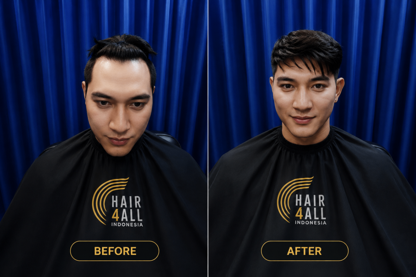 Transformasi klien Hair4All Indonesia 1 — sebelum dan sesudah hair replacement