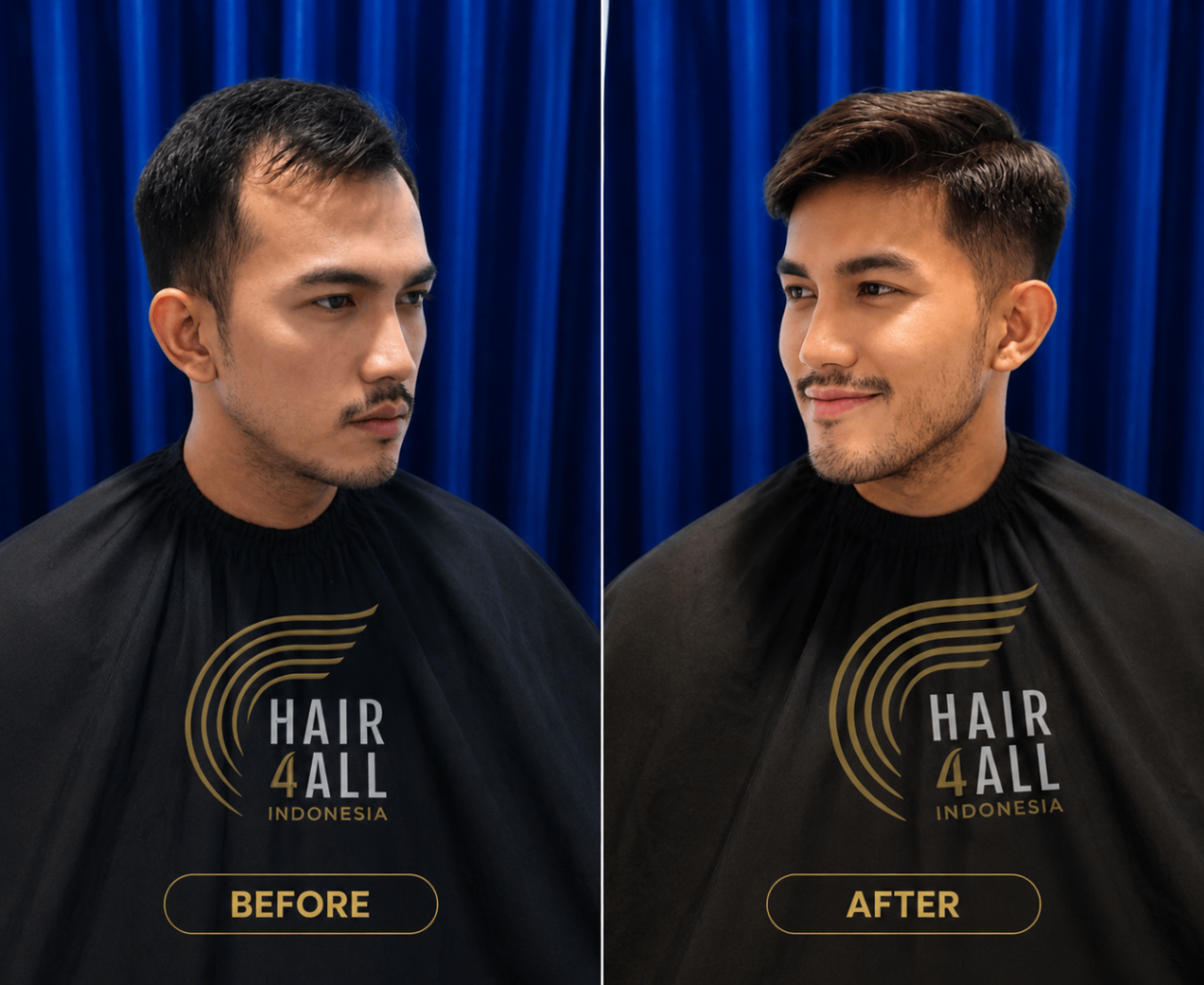 Transformasi klien Hair4All Indonesia 4 — sebelum dan sesudah hair replacement