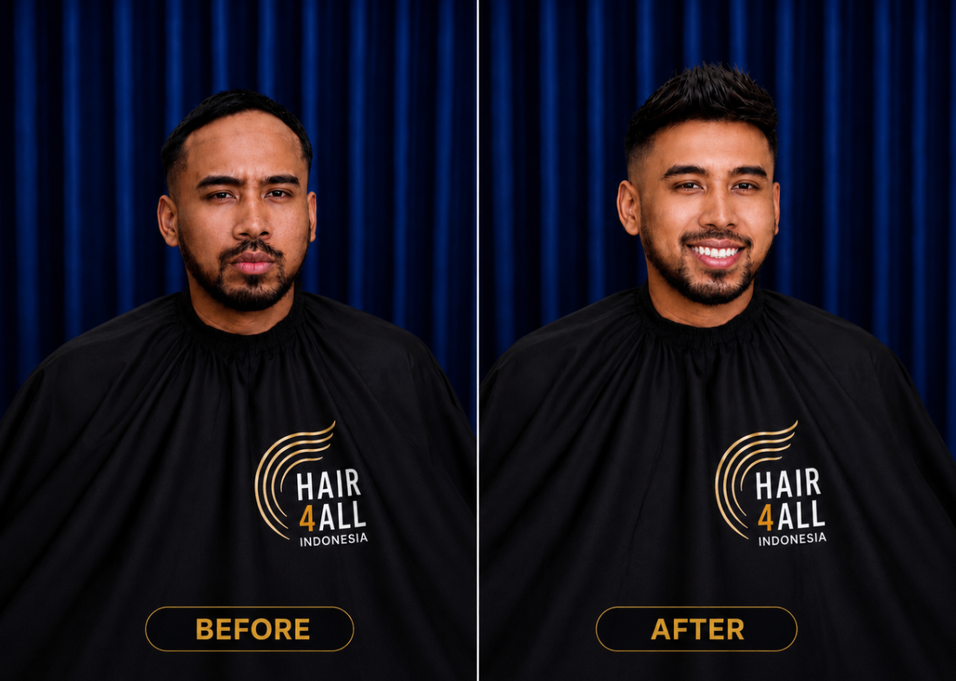 Transformasi klien Hair4All Indonesia 9 — sebelum dan sesudah hair replacement